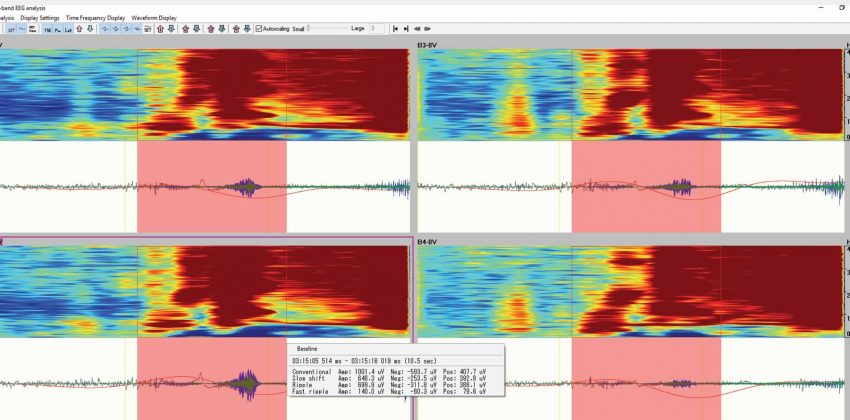 High Frequency Oscillations & Wide Band EEG Analysis